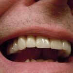 Przebarwienia zębów przy dziąsłach