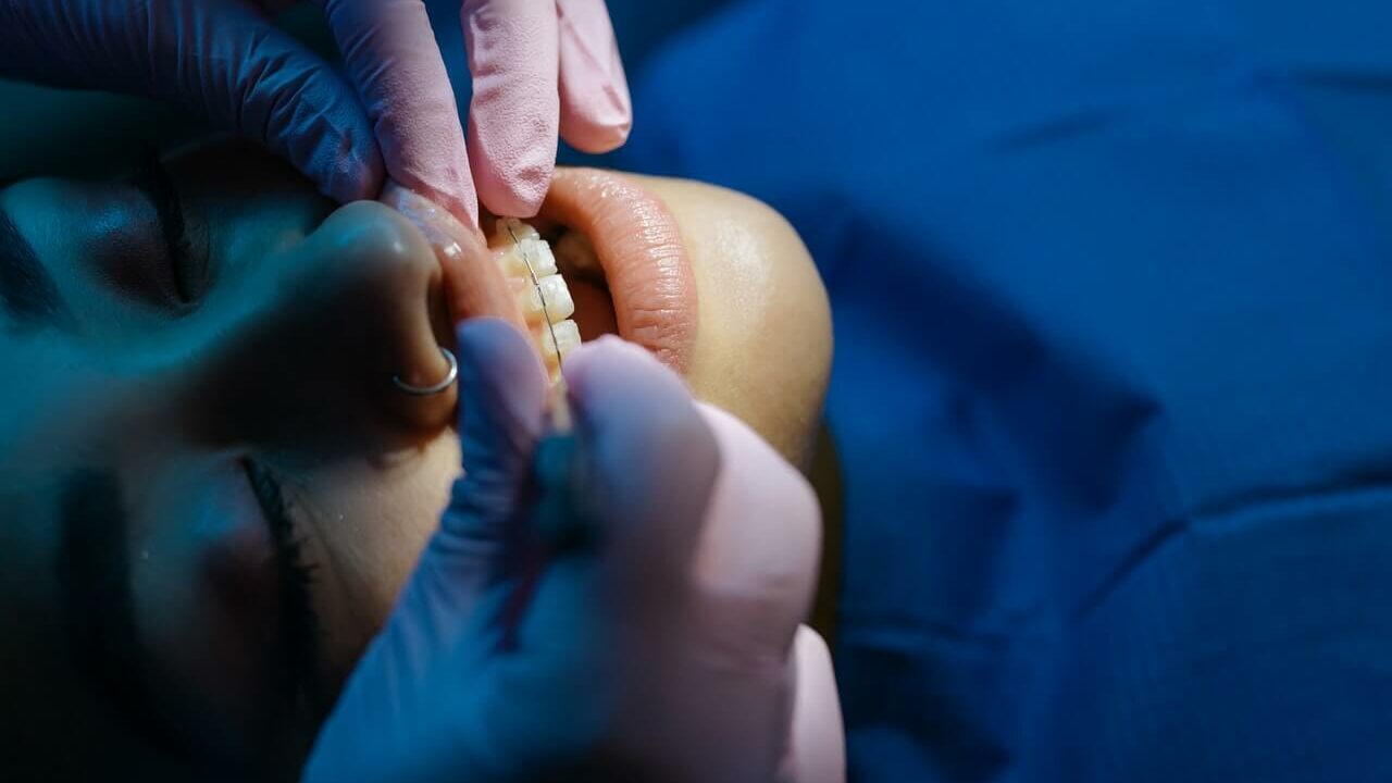 Ekstyrpacja miazgi zęba